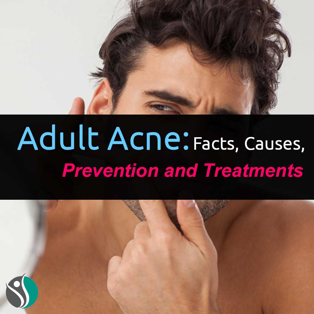Adult Acne: Facts, Causes, Prevention, and Treatments