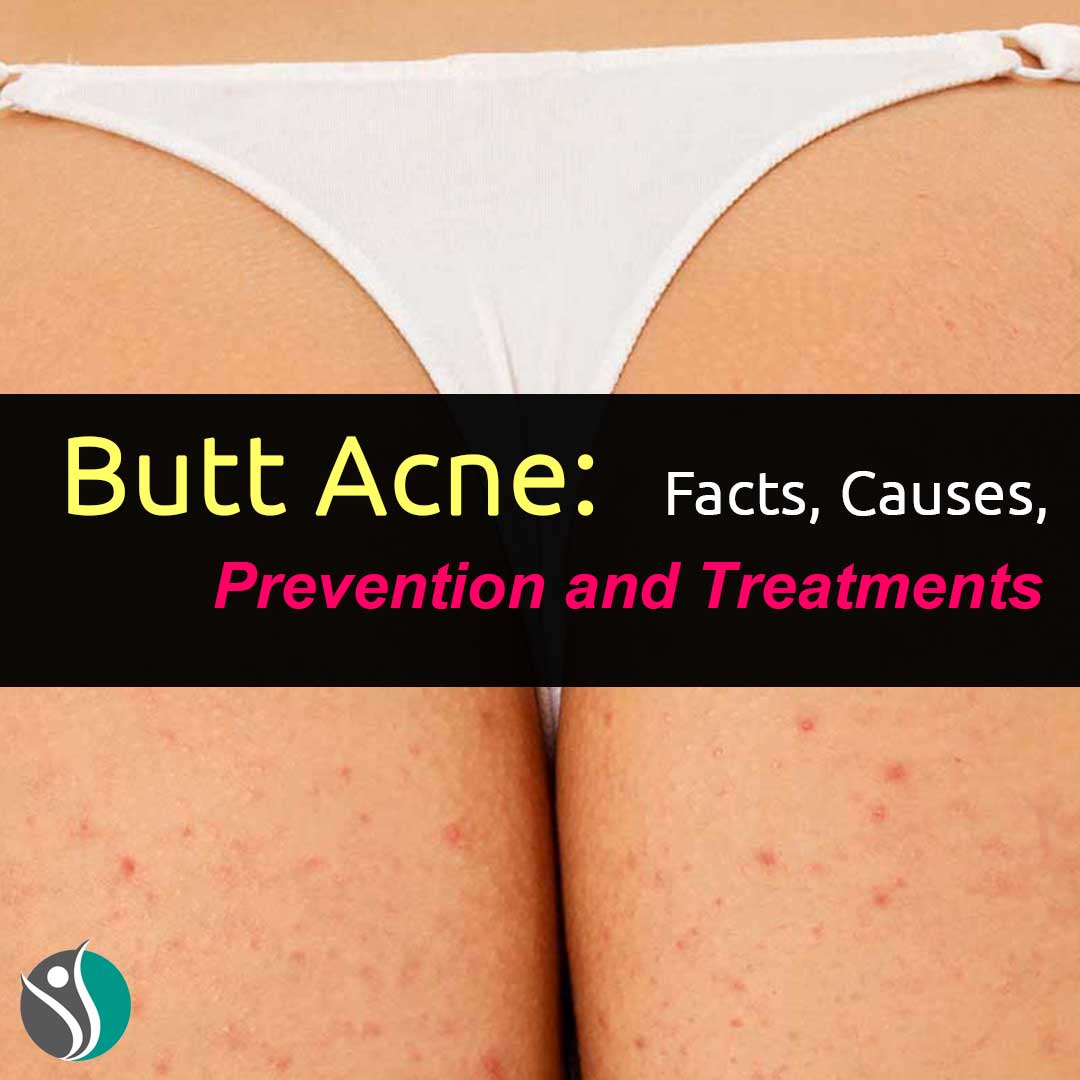  Butt Acne: Facts, Causes, Prevention, and Treatments