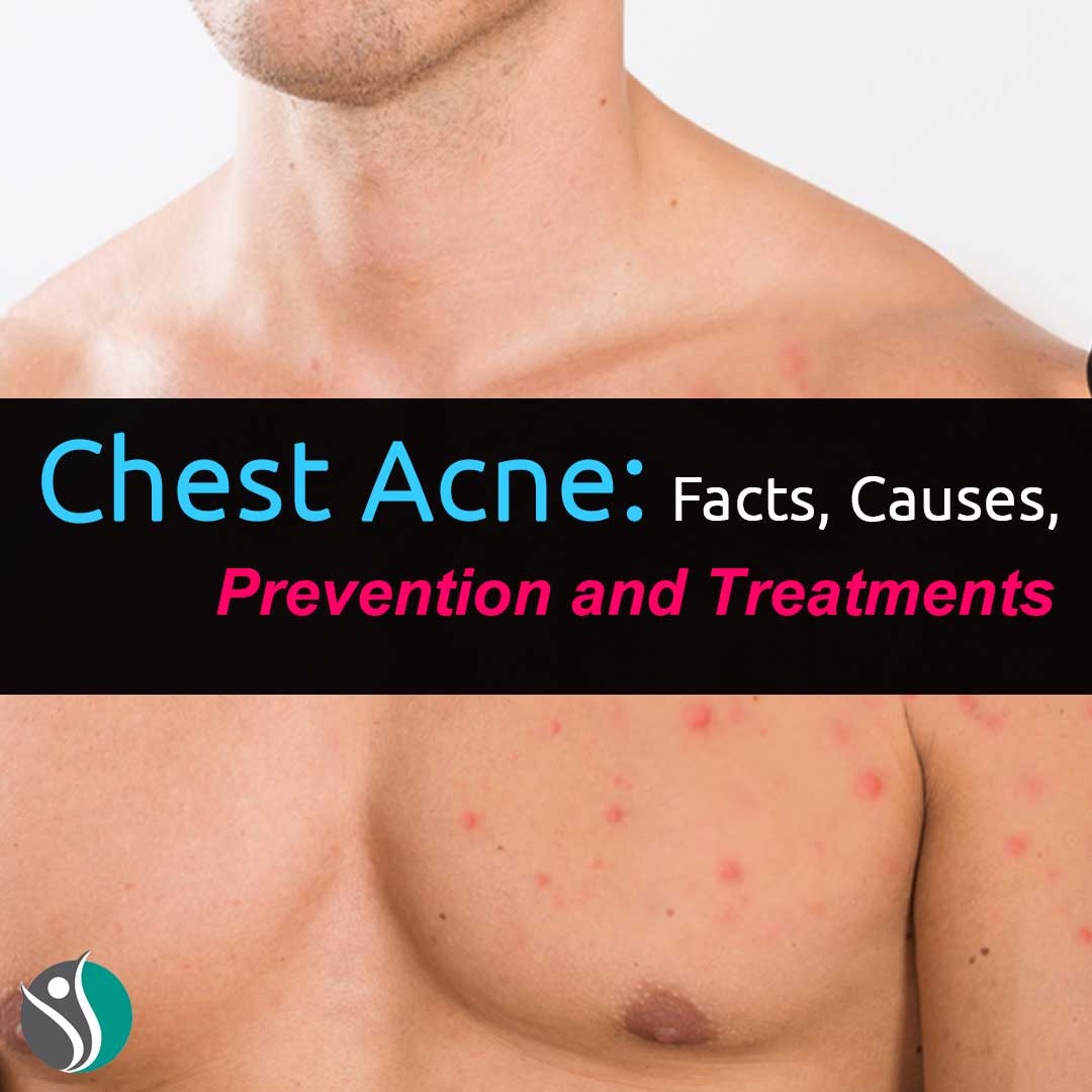 Chest Acne: Facts, Causes, Prevention, and Treatments