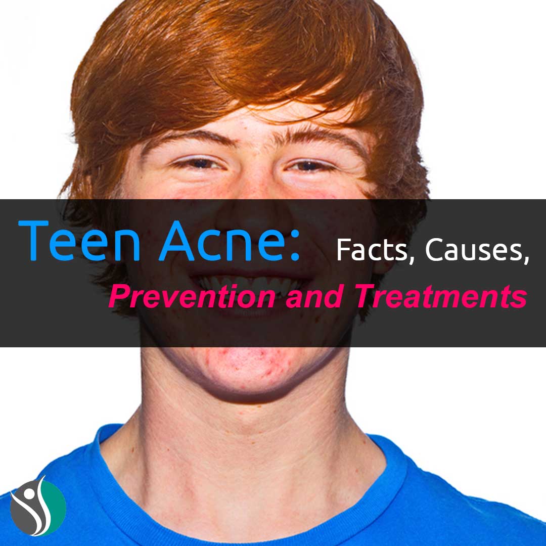 Teen Acne: Facts, Causes, Prevention, and Treatments